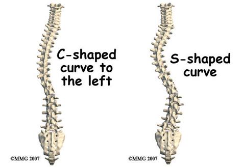 Scoliosis is an abnormal curve of the spine into a 'c' or 's' shape .